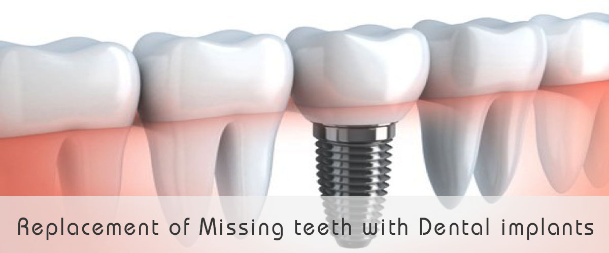 Fixed teeth with Dental Implants